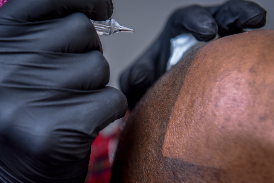 Scalp Micro-pigmentation of bald African-American man