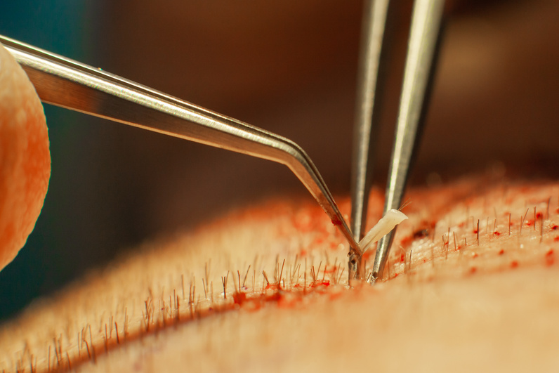 Macrophotography of a hair bulb transplanted into a hairless area. Baldness treatment. Hair transplant. Surgeons in the operating room carry out hair transplant surgery. Surgical technique that moves hair follicles from a part of the head
